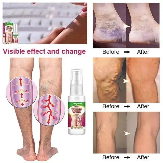 Varicose Veins Treatment Spray by Oz-Direct.com